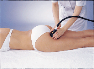 セルライト除去イメージ